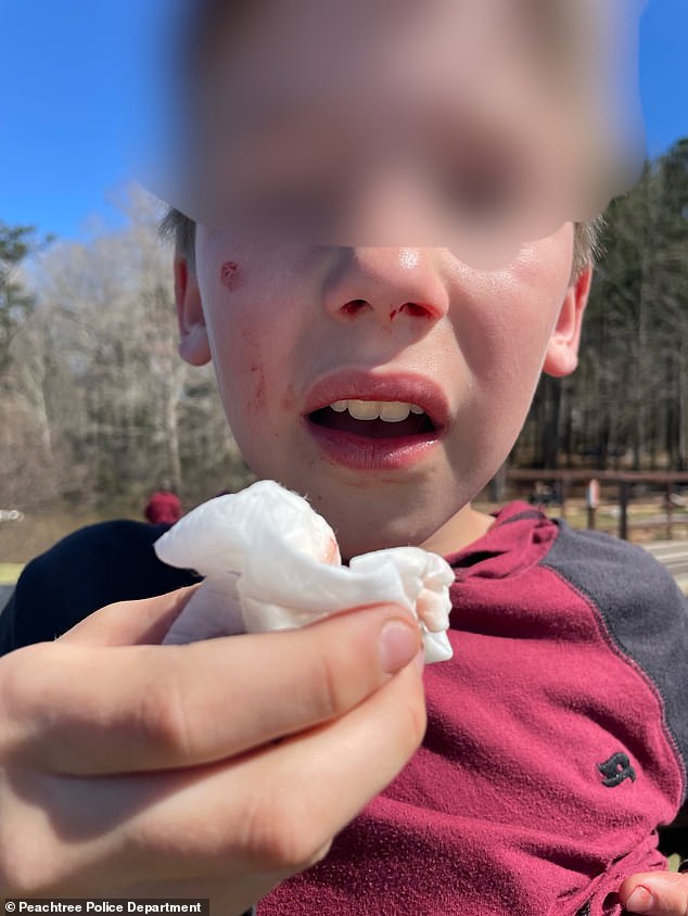 A child in Peachtree City, Georgia, was left with a bloody nose after he was attacked by random teenagers while riding his bike.