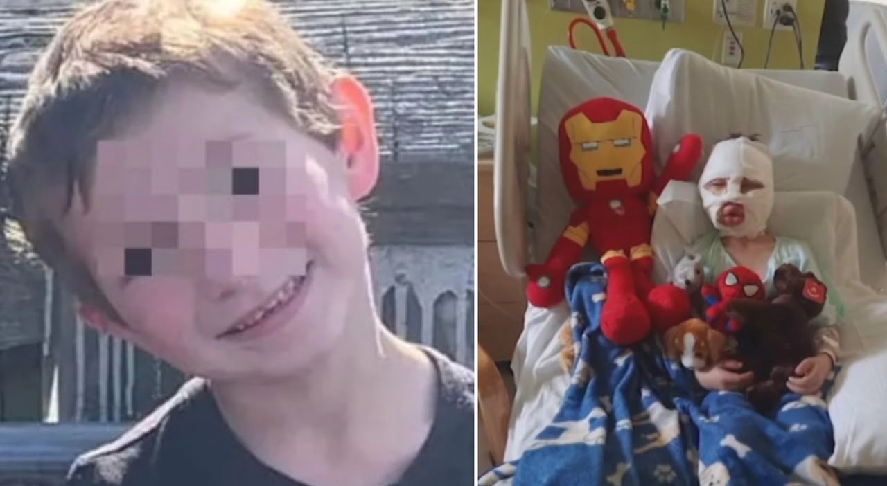 Bully sets a 6 year old boy on fire The