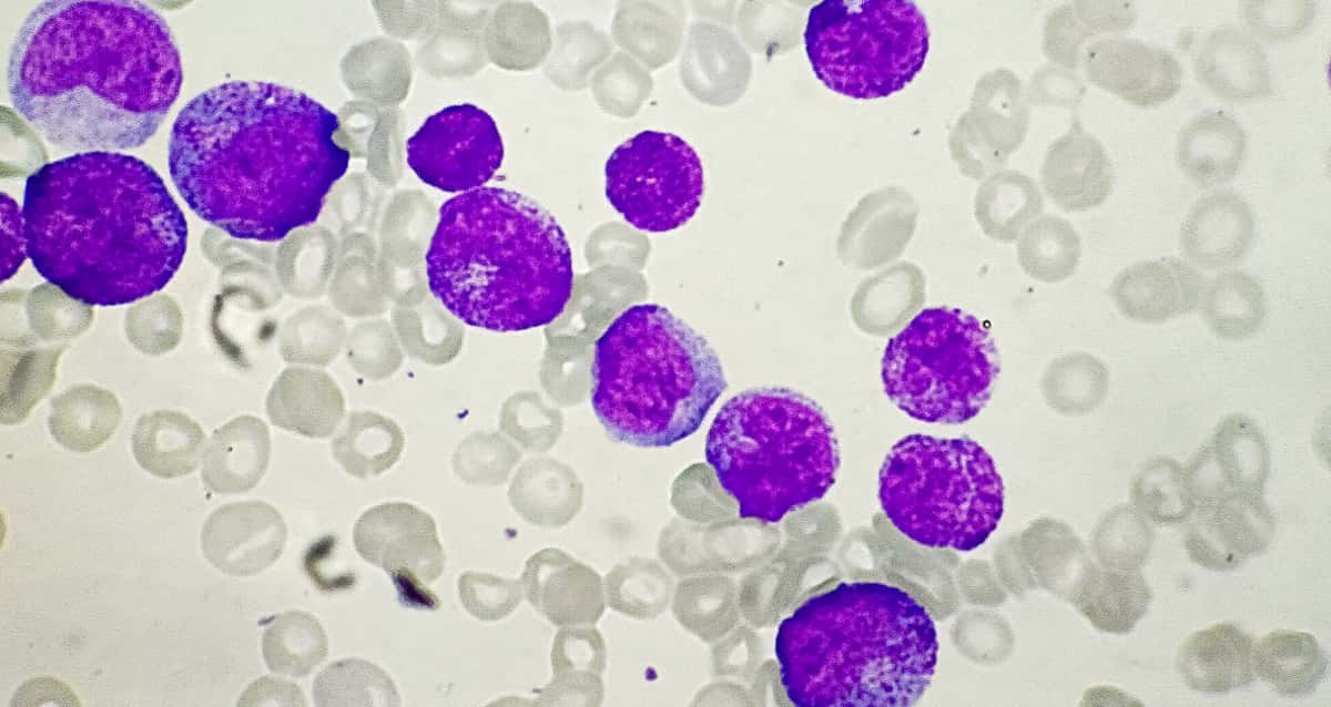 Experimental drug cures 18 people of leukemia