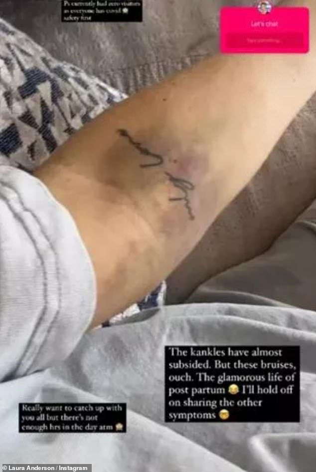 Ouch: The TV star showed off purple bruises on her forearms and in the crook of her elbow, with the injuries appearing to be caused by a cannula inserted to administer medication and the reality of childbirth